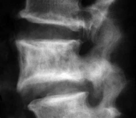 Facet joint osteoarthritis is a common cause of chronic neck pain. - Sumer's Radiology Blog