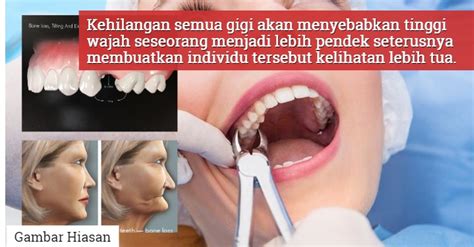 Benarkah mencabut gigi atas bisa menyebabkan kebutaan tribunnews com mobile. Jangan Lupa Pasang Gigi Palsu Bila Sudah Cabut Gigi Kekal ...