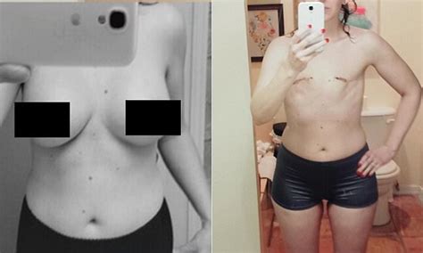 Cancer patient shows off her mastectomy scars on Reddit ...
