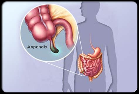 The appendix label appears at the top of the page, bold and centered. Appendicitis & Appendectomy Pictures ~ Your doctor