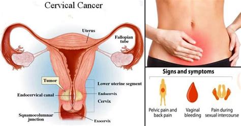 Learn about the causes, symptoms, and treatments. 5 Facts That Cause Cervical Cancer That Girls Should Know!