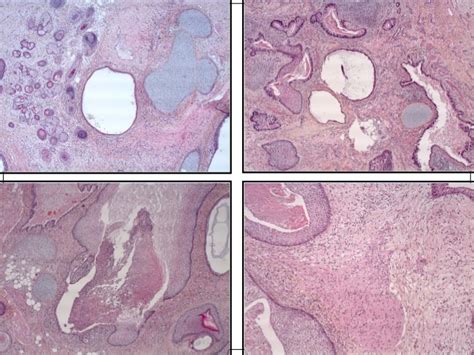 Bump, knob, jutting, bulge, projection, bulbous, conspicuous, gibbose, gibbous. Urology gynecology anapath et imagerie c balleyguier