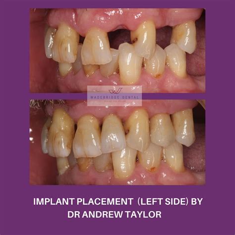 So i had an epiphany in the middle of one project and thought, why do my sims brush their teeth? DENTAL IMPLANTS - Wadebridge Dental Care