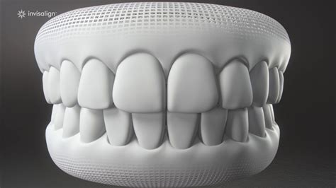 Dental impressions help your dentist plan your treatment. Video How Invisalign Works - YouTube