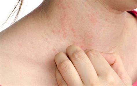 Ces allergies peuvent occasionner de fortes réactions avec de petites quantités de l'allergène, voire des œdèmes de quincke potentiellement mortels. Comment faire face aux allergies