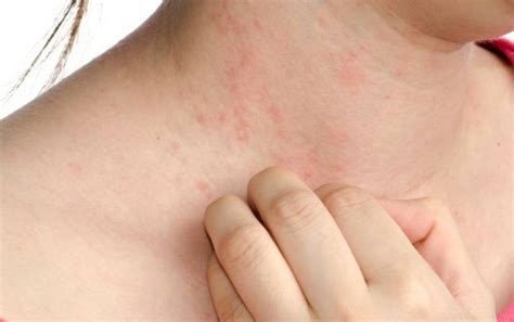 L'urticaire provoque une éruption cutanée de boutons et plaques de peau gonflés qui démangent beaucoup le plus souvent. Comment faire face aux allergies