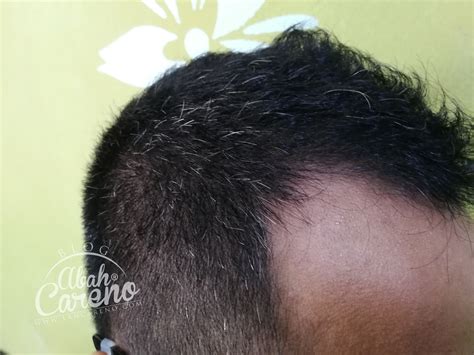 Lesi putih yang disebabkan trauma rangsangan chemis dan physis a. Pomade khas untuk lebatkan rambut dan hitamkan rambut uban ...