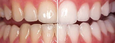 Does teeth whitening really work? Teeth Whitening - MG Dental Clinic