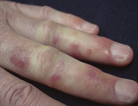 Erythema nodosum is considered to be a hypersensitivity response to different provoking agents. Erythema nodosum Causes, Symptoms and Treatment - Mediologiest