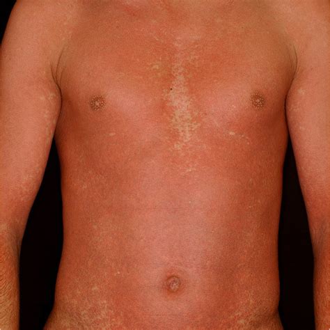 More than 65% of patients with mononucleosis experienced rash. Positive cutaneous response (Penicillin allergenic ...