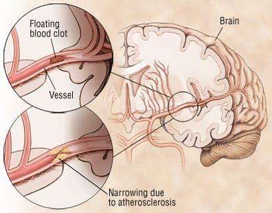 Patient Basics: Transient Ischemic Attack (TIA) | 2 Minute ...