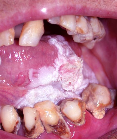 Leukoplakia describes white patches on the roof of the mouth, tongue, and gums. Leukoplakia. Causes, symptoms, treatment Leukoplakia
