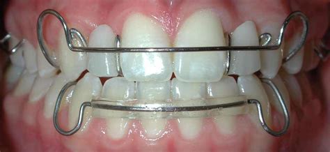 What are fixed retainers good for. Types of Orthodontic Retainers - Tribeca Dental Care