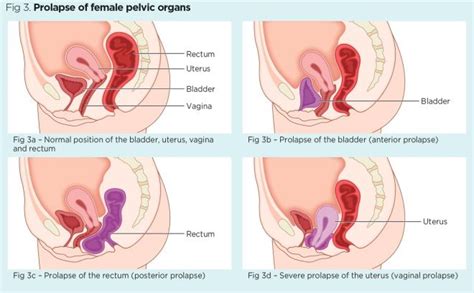 Female internal organs reproductive system anatomy. Female pelvic floor 1: anatomy and pathophysiology ...