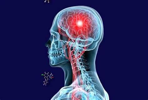 También puede denominarse aneurisma intracraneal o aneurisma cerebral. Pin en articulos interesantes