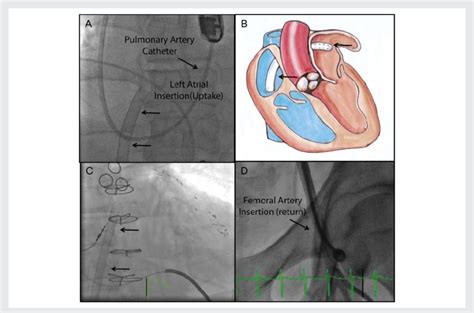 Tandem hearts is screening friday at indie fest usa in the los angeles area! The figure shows placement of a TandemHeart percutaneous ventricular... | Download Scientific ...