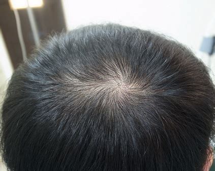 はげ治療、ハーグ療法に100万円以上かけ続ける年収240万 ...