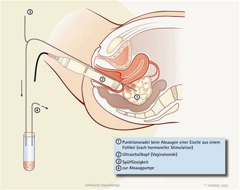 Dem deutschen embryonenschutzgesetz zufolge dürfen pro zyklus maximal so viele entwicklungsfähige embryonen entstehen, wie der patientin übertragen werden sollen. Behandlung IVF/ICSI - Behandlung bei unerfülltem Kinderwunsch