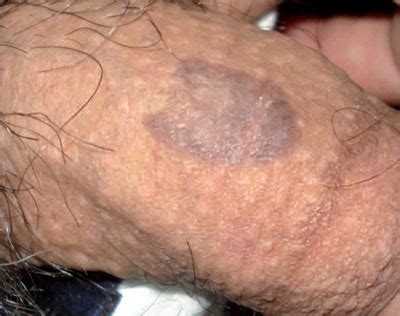 Les maladies de la peau peuvent être accompagnées par certaines pierres. Maladies du pénis; maladies peniennes