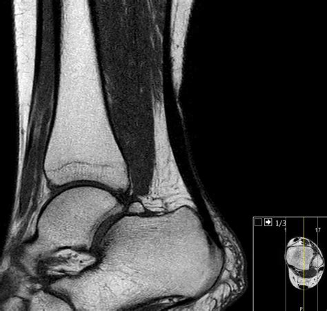 Die diagnose einer peronealsehnenluxation sollte anlass geben, hier eine operative behandlung anzustreben, um die peronealsehne wieder in den geeigneten gelenklauf zu versetzen. Achillessehne