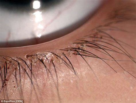 Your eyes need to be fully developed before you can get lasik. Four-year-old girl in China had over 20 pubic lice living ...