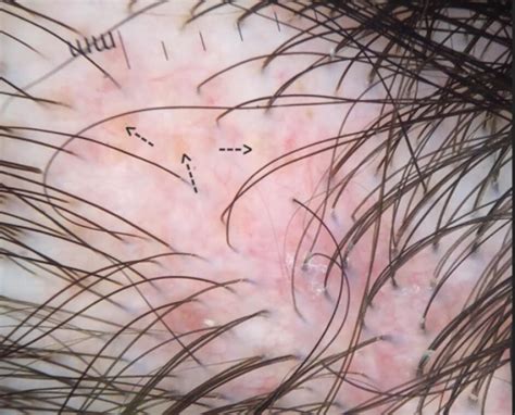 Lupus hair in sle is a poorly characterised entity. Early Discoid lupus erythematosus — Donovan Hair Clinic