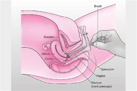 If the cancer has spread to your nearby organs, it can affect how those organs work too. Cervical screening: helping you decide - GOV.UK