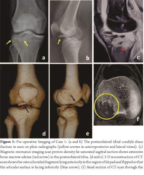 Injuries of the posterior cruciate ligament (pcl). Anterior Cruciate Ligament Rupture with Medial Collateral ...