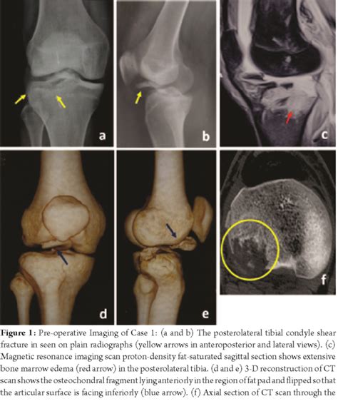 The injury is common in the knee, ankle, and wrist. Anterior Cruciate Ligament Rupture with Medial Collateral ...