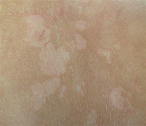 Spots appear that are lighter or darker than the surrounding skin, usually on the trunk or neck. Tinea Versicolor: What It Is And How To Treat | Family Savvy