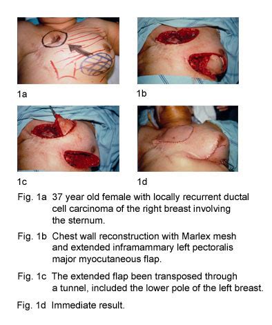 Find out about the symptoms of breast cancer recurrence, including tips on coping with worries about your cancer returning. P2 - Aggressive Surgical Resection and Reconstruction for ...