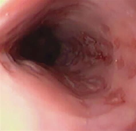 Infective esophagitis hiv esophagitis cmv esophagitis herpes esophagitis candida esophagitis. Clinical, Imaging, and Pathologic Features of Conditions ...