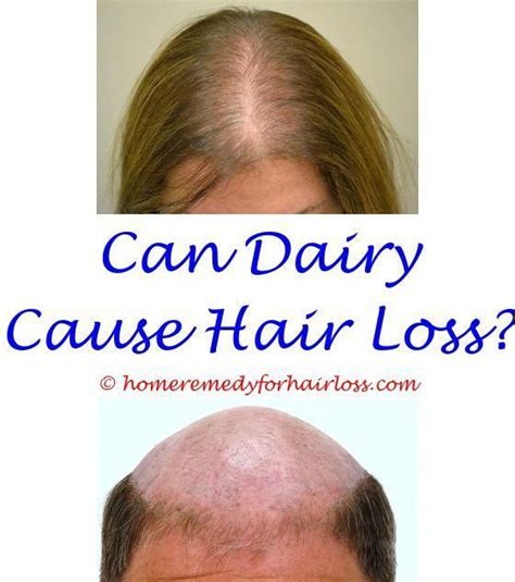 Vitamin d is responsible for reinforcing the hair follicles and making them strong. Copper Deficiency Hair Loss - Best Hairstyles in 2020 ...