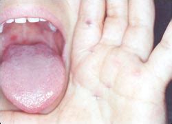 Hand, foot and mouth disease is a common infection that causes mouth ulcers and spots on the hands and feet. :: 소아가정 간호백과17 - 소아청소년 피부 질환 :: - 수족구병과 피부 발진 Hand-foot ...