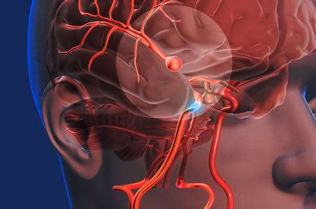 Read about brain aneurysm (cerebral aneurysm) symptoms, signs, surgery, causes, survival rates, recovery, treatment, coiling, prognosis, survival rate, statistics, rupture, and more. Aneurisma Cerebral