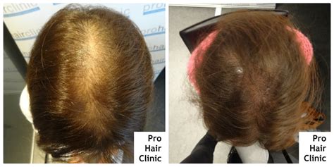 Leiden auch sie unter haarausfall und betrachten täglich sorgenvoll ihre geheimratsecken im spiegel? Haartransplantation Forum : Haartransplantation allgemein ...