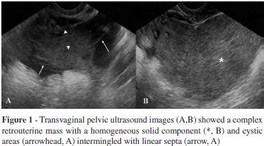 To show how the evaluation for endometriosis can be included in the routine pelvic ultrasound examination. Pelvic Ascites Ultrasound