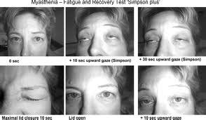 In myasthenia gravis, the voluntary muscles become weak, causing the eyelids to droop, among other problems. professional nursing practice: Myasthenia Gravis