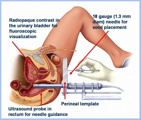 A prostate massage is most commonly 2. 11 Risks associated with prostate brachytherapy - DIY ...