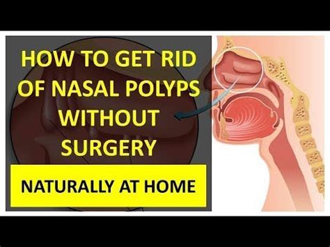 Polyps can grow large enough to block your nasal passages, resulting in chronic congestion. How to Get Rid of Nasal Polyps Without Surgery Naturally ...