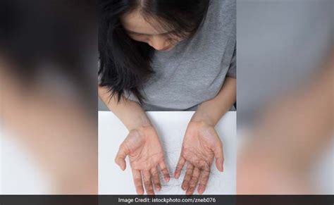 And disappear when she stops armour. Are You Having Excessive Hair Loss? Know the Causes