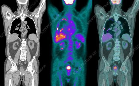 2016 san antonio breast cancer symposium. Mesothelioma lung cancer, CT and PET - Stock Image - C021 ...