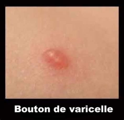 (hors prix noirs (exemple joie), destockage, mobilier, couches bébé cash)*. Image, Photo Varicelle (bouton), Dermatologie - Vulgaris ...