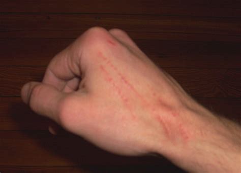 What are the signs of an infected cat scratch? Cat Scratch Fever Can Be Terrifying - Fluffy The Vampire ...