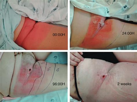 A groin hernia refers to the protrusion of abdominal contents such as fat, small or large illustration figure 1: Evolution of groin infection. | Download Scientific Diagram