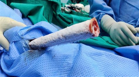 How do i know if i have breast cancer? 'Ice Cream Stick Technique' will now cure bone cancer ...