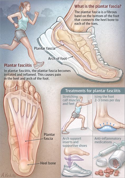 How much do you know about plantar fasciitis? Plantar Fasciitis | Lifestyle Behaviors | JAMA | JAMA Network