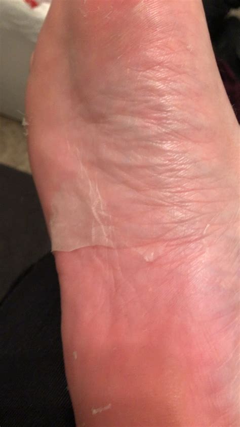 After using a foot peel 😍 : peeling