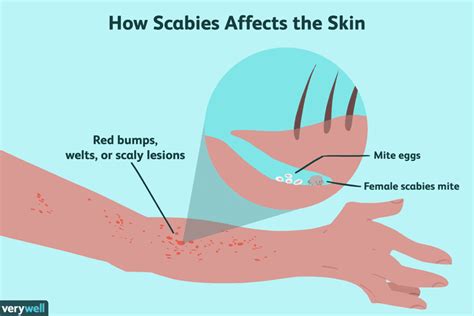 Only then are they able to be killed by certain treatments. How to Prevent Scabies