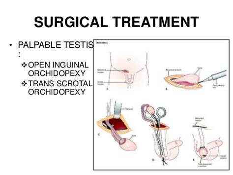 Cryptorchidism is the absence of one or both testes from the scrotum. Development of testis & cryptorchidism presentation